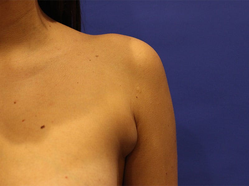 Side Breast Tissue Removal
